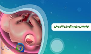 توانبخشی میلومننگوسل با کاردرمانی