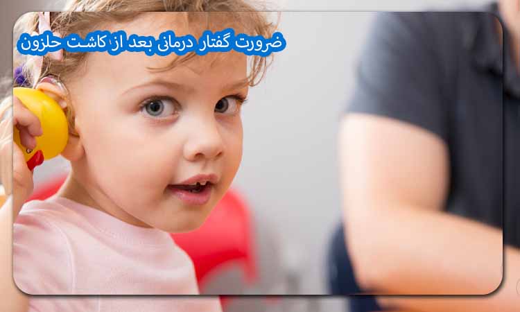 ضرورت گفتار درمانی بعد از کاشت حلزون