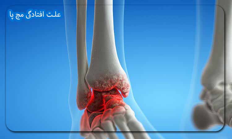 علت افتادگی مچ پا