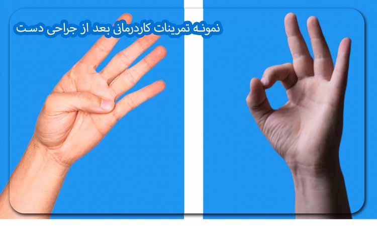نمونه تمرینات کاردرمانی بعد از جراحی دست