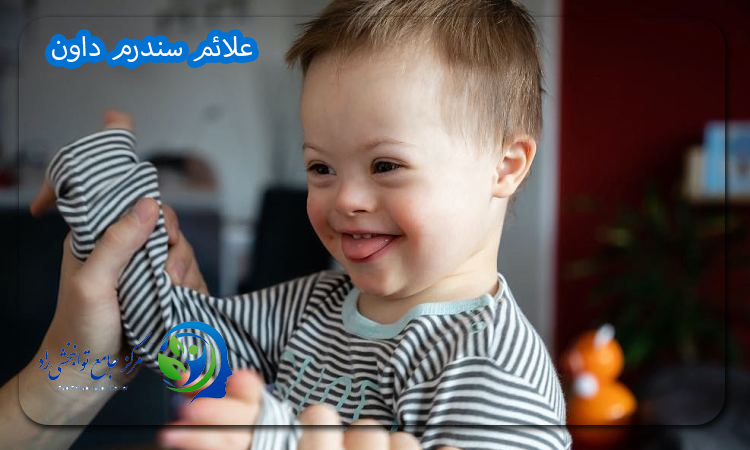 علائم سندرم داون