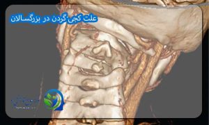 علت کجی گردن در بزرگسالان