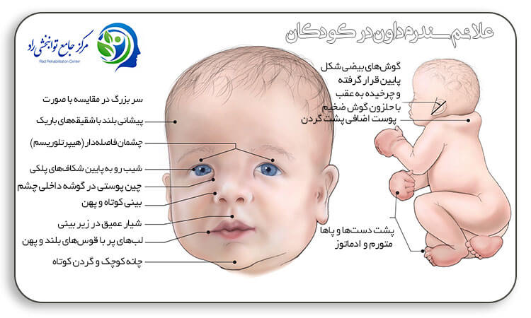 علائم سندروم دان در کودکان