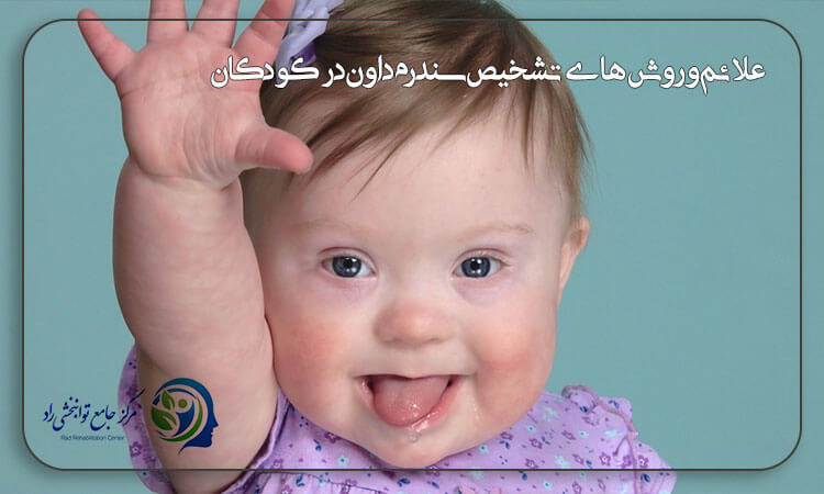 سندرم داون در کودکان