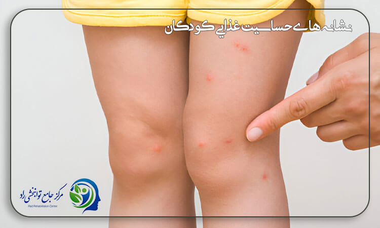 نشانه های حساسیت غذایی کودکان زیر 2 سال