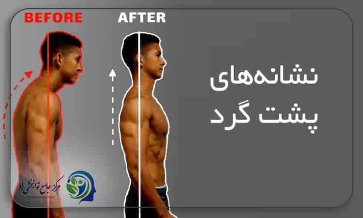 علائم و نشانه های پشت گرد