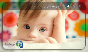 نوزاد سندروم داون